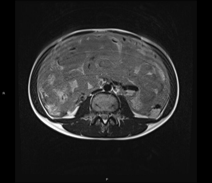File:Burkitt lymphoma (bowel) (Radiopaedia 68839-78557 Axial T2 35).jpg