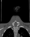 Butterfly vertebra (Radiopaedia 77903-90209 Coronal bone window 60).jpg
