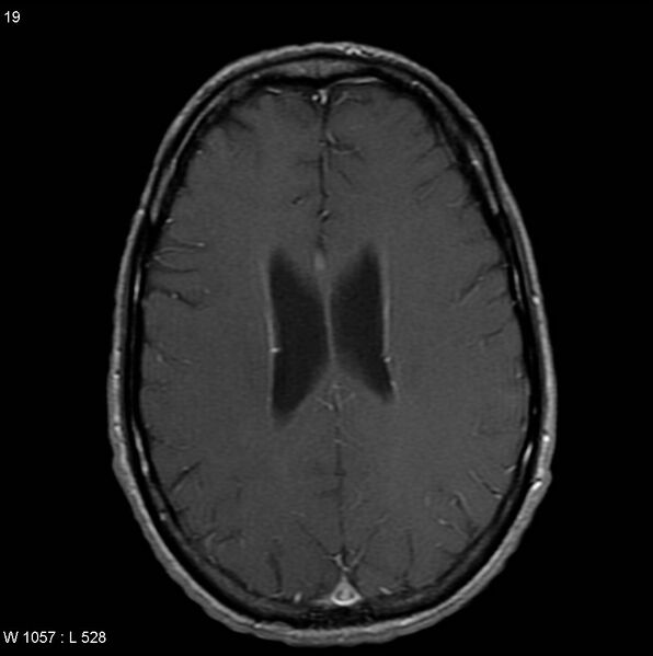 File:CMV ventriculitis and encephalitis (Radiopaedia 5416-7166 Axial T1 C+ 8).jpg