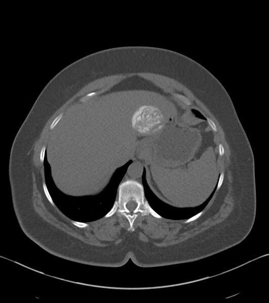 File:Calcified hepatic hydatid cyst (Radiopaedia 81127-94738 Axial non-contrast 17).jpg