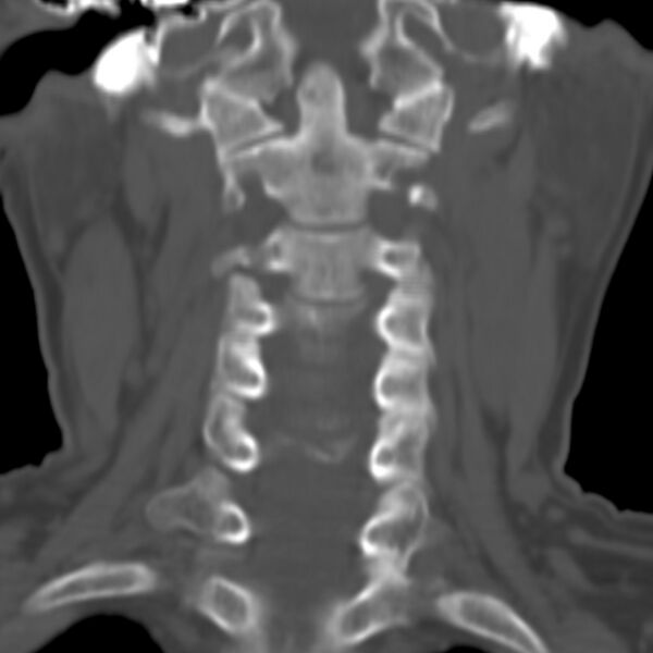 File:Calcified meningioma - cervical canal (Radiopaedia 70136-80171 Coronal bone window 8).jpg