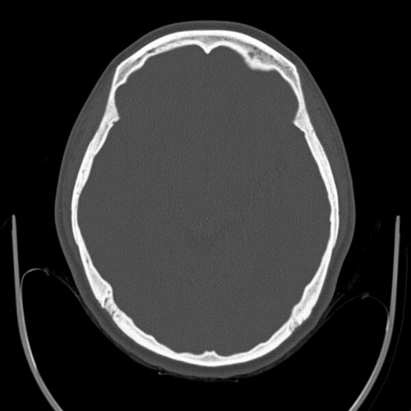 File:Calvarial osteoma (Radiopaedia 36520-38079 Axial bone window 47).jpg