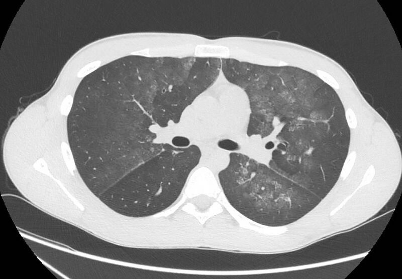 File:Cannabis-induced diffuse alveolar hemorrhage (Radiopaedia 89834-106946 Axial lung window 48).jpg