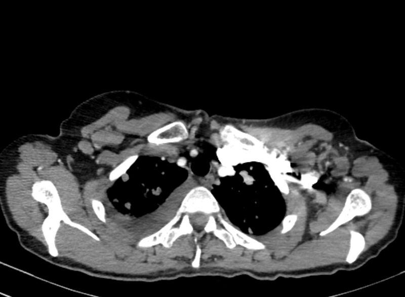 File:Cannonball metastases from breast cancer (Radiopaedia 91024-108569 A 23).jpg