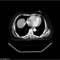 Carcinoma cervix- recurrence (Radiopaedia 34702-36137 B 4).jpg