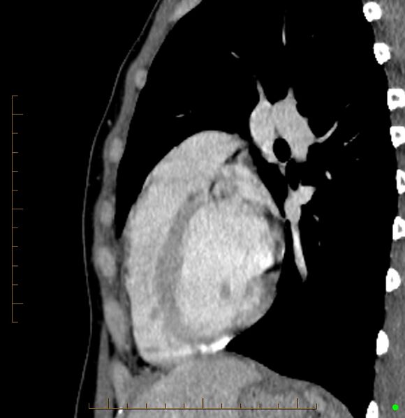 File:Cardiac paraganglioma (Radiopaedia 76345-88005 C 32).jpg