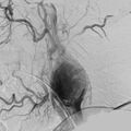 Carotid body tumor on angiography (Radiopaedia 4651-6729 A 5).jpg