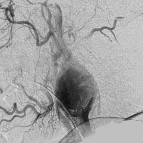 File:Carotid body tumor on angiography (Radiopaedia 4651-6729 A 5).jpg