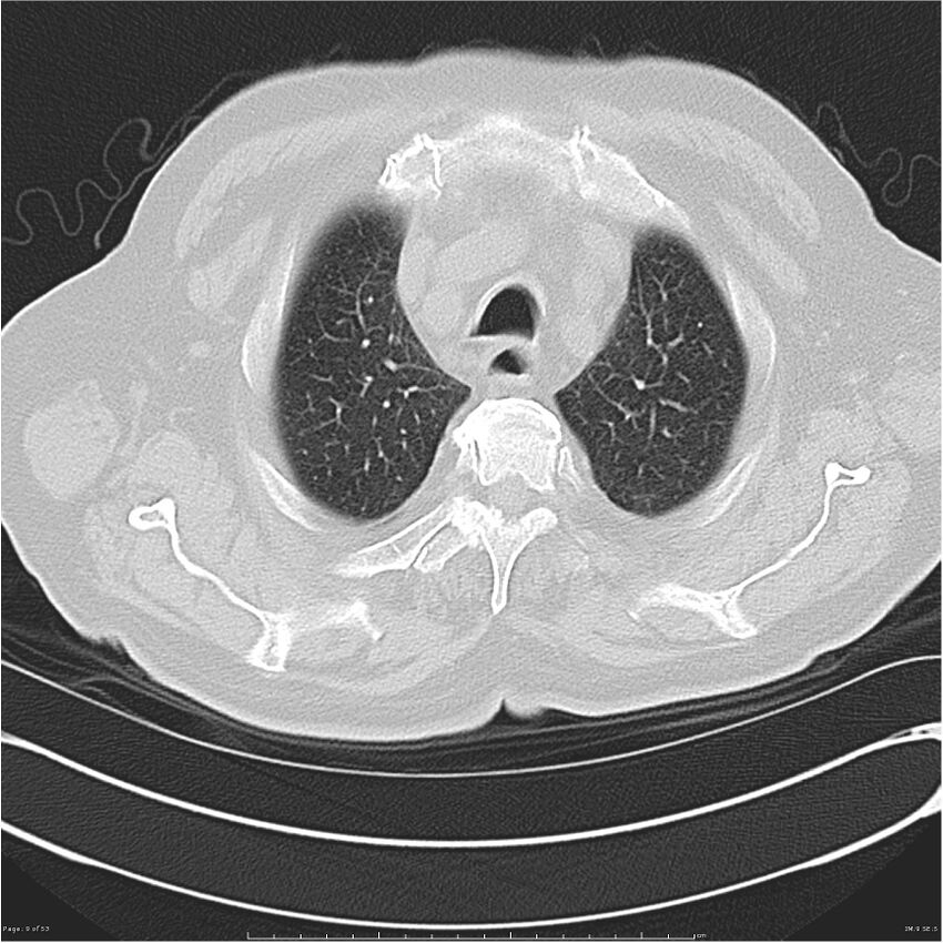 Cavitating left lower lobe lesion - squamous cell lung cancer (Radiopaedia 27749-28176 Axial lung window 9).jpg