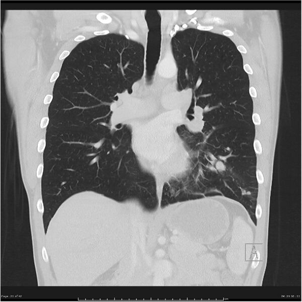 File:Cavitating lung cancer (Radiopaedia 25796-25945 lung window 21).jpg