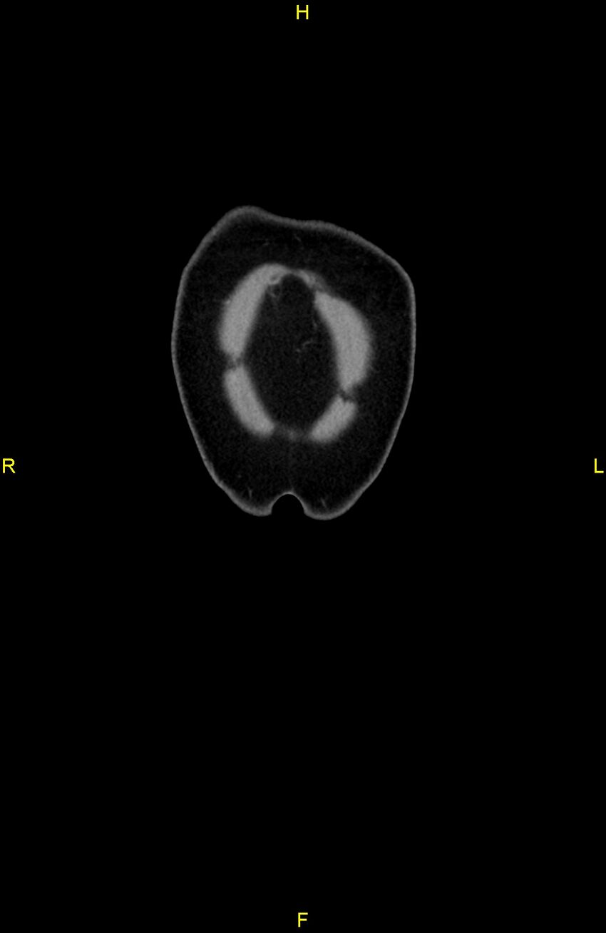 Cecal epiploic appendagitis (Radiopaedia 86047-102164 B 2).jpg