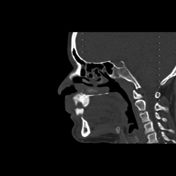 File:Cemento-ossifying fibroma (Radiopaedia 21243-21149 Sagittal bone window 9).jpg