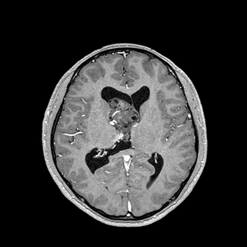 Central neurocytoma (Radiopaedia 79320-92380 Axial T1 C+ 133).jpg