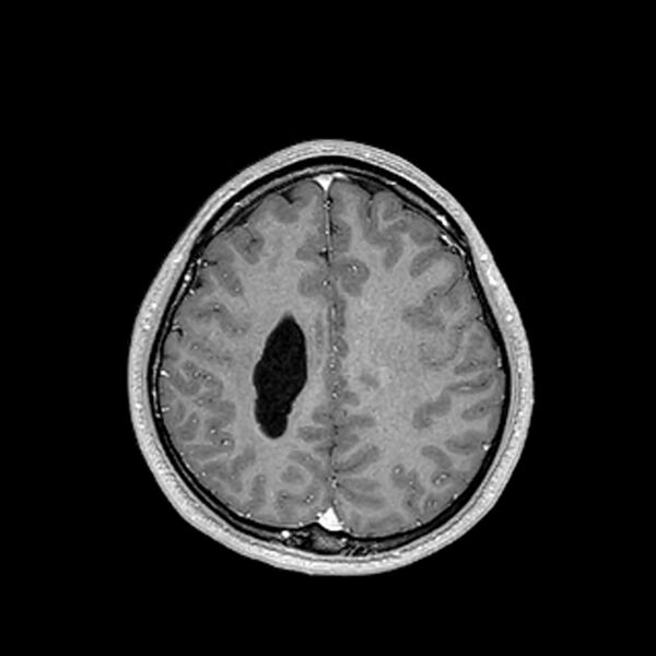 File:Central neurocytoma (Radiopaedia 79320-92380 Axial T1 C+ 174).jpg