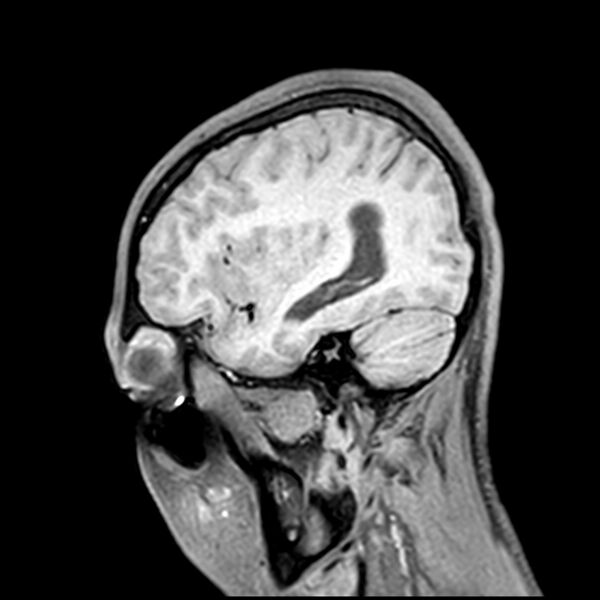 File:Central neurocytoma (Radiopaedia 79320-92380 Sagittal T1 195).jpg