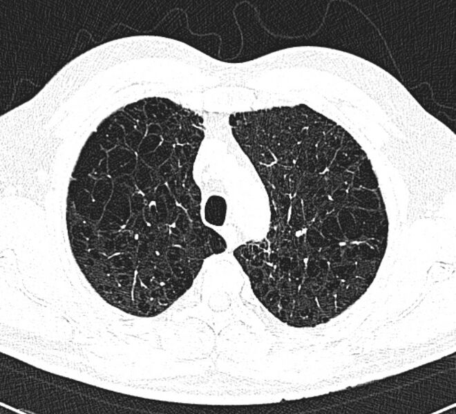 File:Centrilobular pulmonary emphysema (Radiopaedia 26808-26971 Axial lung window 9).jpg