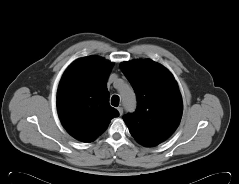 File:Centrilobular pulmonary emphysema (Radiopaedia 26808-26971 Axial non-contrast 10).jpg