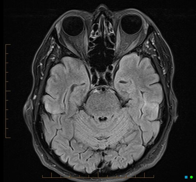 File:Cerebellar gangliocytoma (Radiopaedia 65377-74422 Axial FLAIR 12).jpg