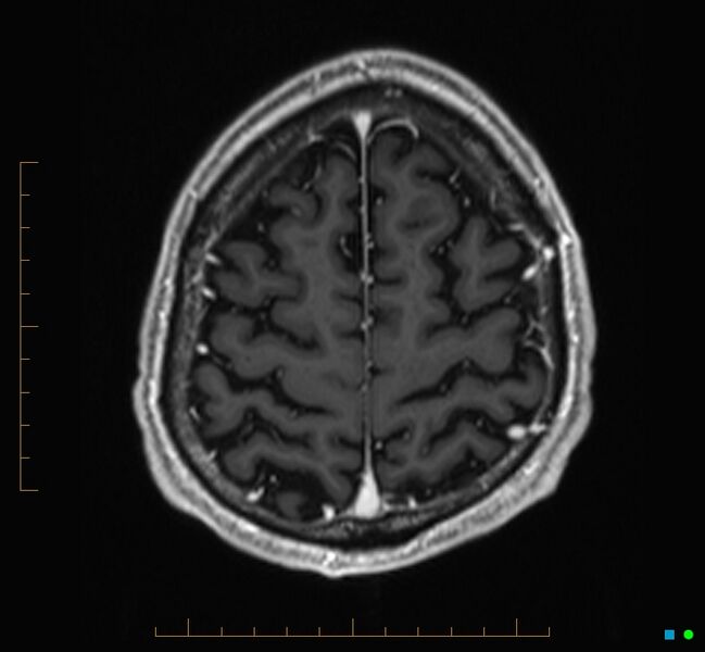 File:Cerebellar gangliocytoma (Radiopaedia 65377-74422 Axial T1 C+ 120).jpg