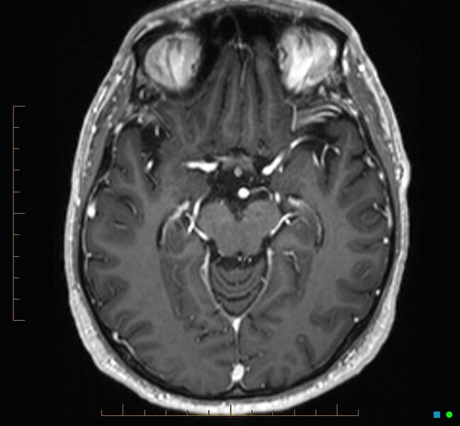 File:Cerebellar gangliocytoma (Radiopaedia 65377-74422 Axial T1 C+ 51).jpg