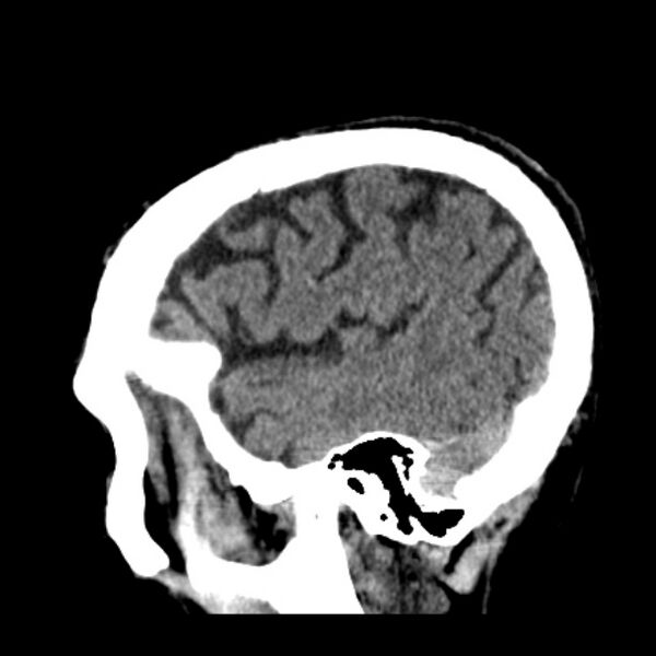 File:Cerebellar hemorrhage (Radiopaedia 27193-27359 C 37).jpg