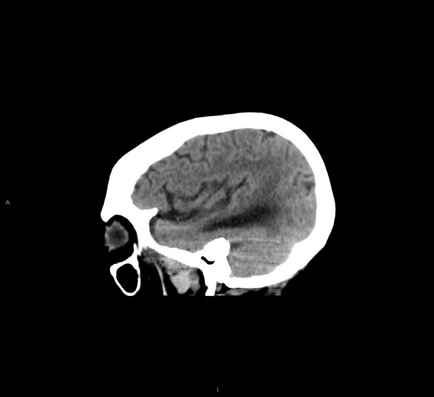 Cerebellar hemorrhage (Radiopaedia 58793-66027 C 40).jpg