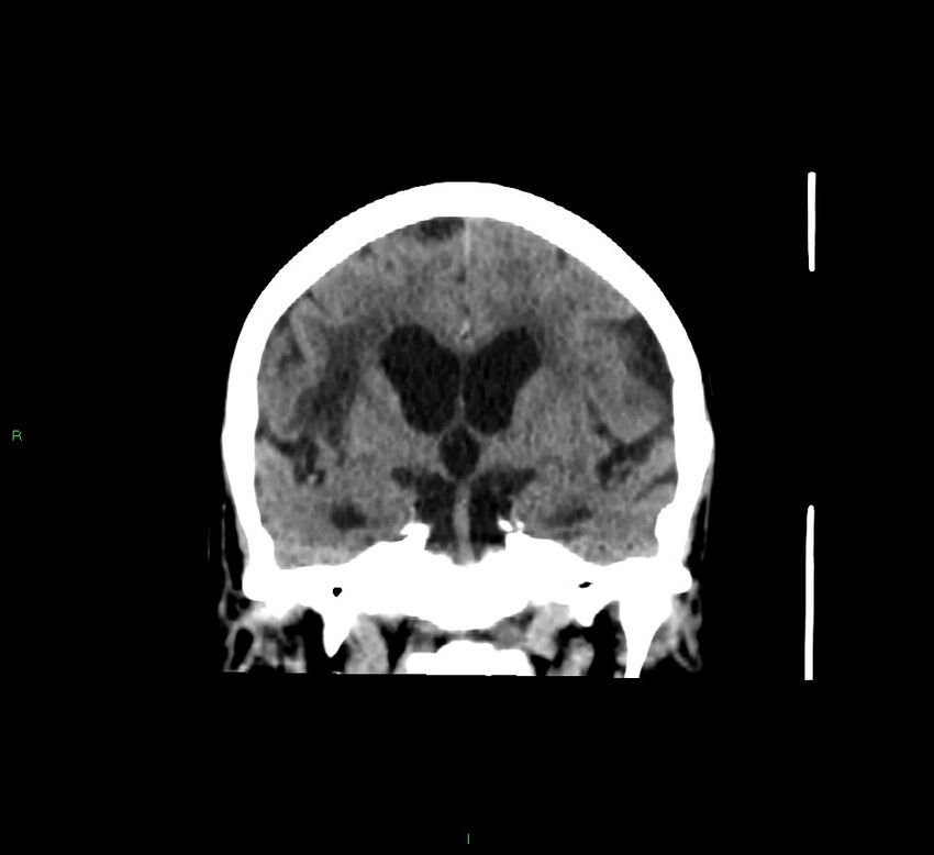 Cerebellar hemorrhage (Radiopaedia 58793-66027 Coronal non-contrast 40).jpg