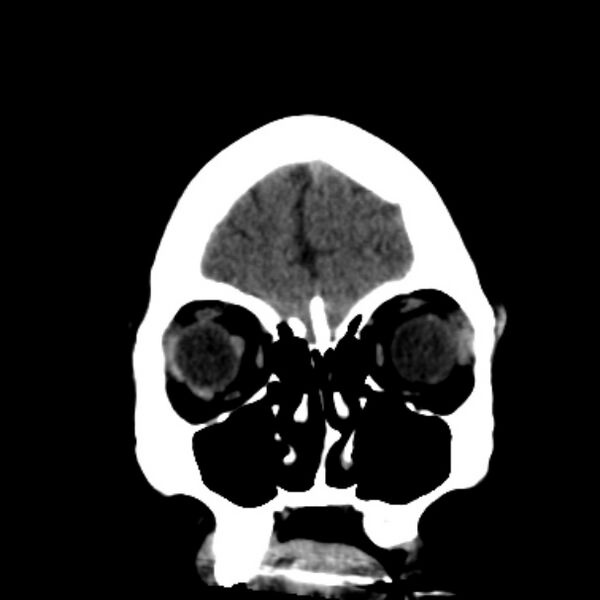 File:Cerebellar hemorrhage causing obstructive hydrocephalus (Radiopaedia 33989-35207 Coronal non-contrast 11).jpg