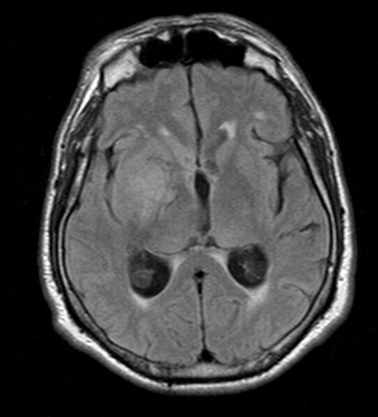 File:Cerebellopontine angle meningioma (Radiopaedia 24459-24764 Axial FLAIR 13).jpg