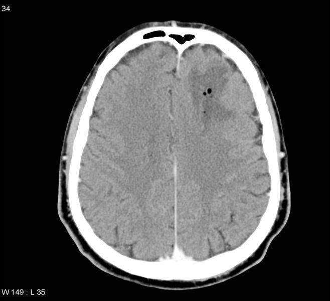 File:Cerebral abscess (Radiopaedia 5150-6933 Axial C+ delayed 3).jpg