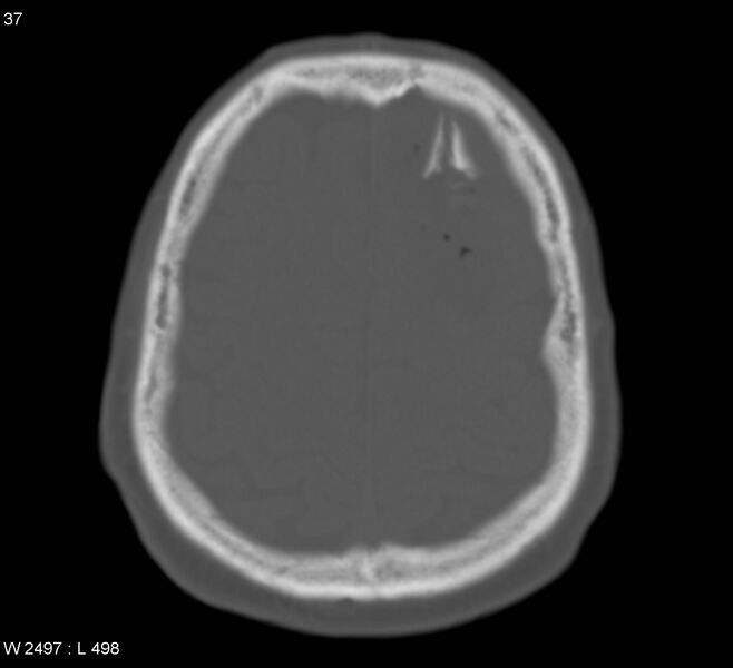 File:Cerebral abscess (Radiopaedia 5150-6933 Axial bone window 1).jpg