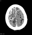 Cerebral abscesses secondary to contusions (Radiopaedia 5201-6967 Axial C+ delayed 10).jpg