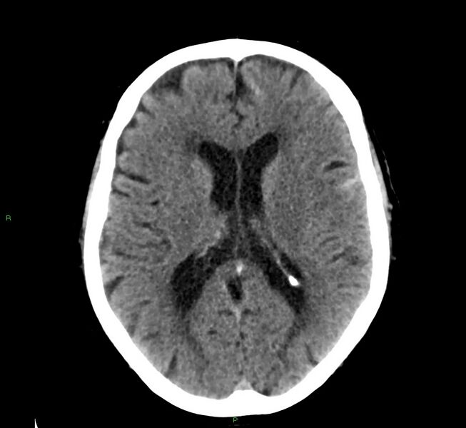 File:Cerebral amyloid angiopathy-associated lobar intracerebral hemorrhage (Radiopaedia 58376-65511 Axial non-contrast 28).jpg