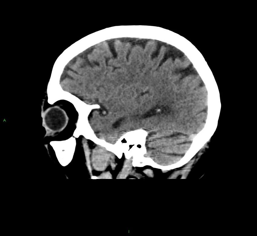 Cerebral amyloid angiopathy-associated lobar intracerebral hemorrhage (Radiopaedia 58376-65511 C 15).jpg
