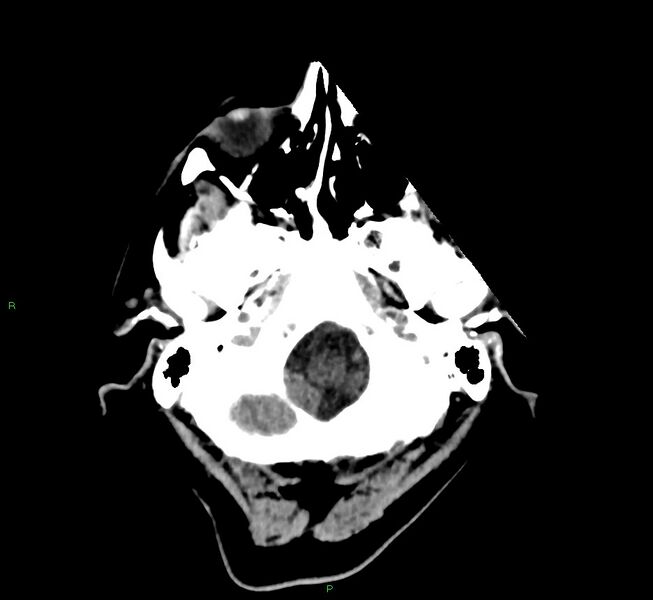 File:Cerebral amyloid angiopathy-associated lobar intracerebral hemorrhage (Radiopaedia 58376-65513 Axial non-contrast 45).jpg