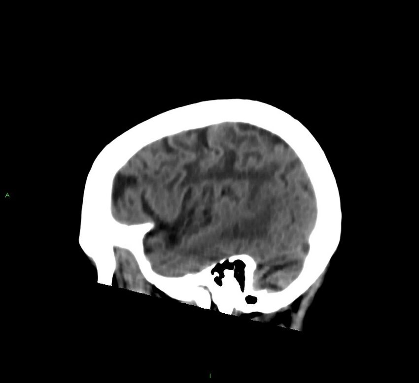 Cerebral amyloid angiopathy-associated lobar intracerebral hemorrhage (Radiopaedia 58376-65513 C 53).jpg
