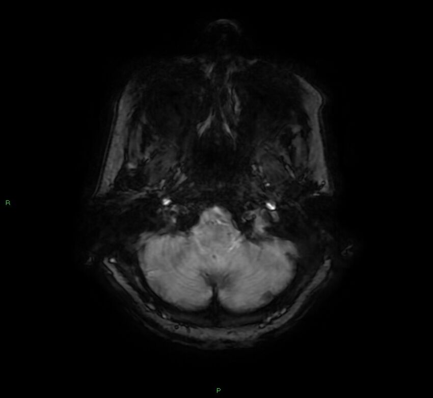 Cerebral amyloid angiopathy-associated lobar intracerebral hemorrhage (Radiopaedia 58378-65517 Axial SWI 10).jpg