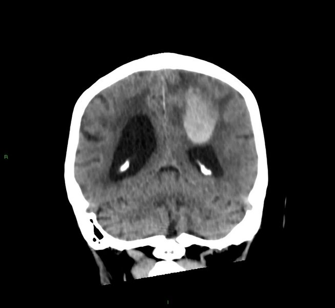 File:Cerebral amyloid angiopathy-associated lobar intracerebral hemorrhage (Radiopaedia 58530-65688 Coronal non-contrast 24).jpg