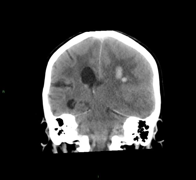 File:Cerebral amyloid angiopathy-associated lobar intracerebral hemorrhage (Radiopaedia 58561-65724 Coronal non-contrast 27).jpg