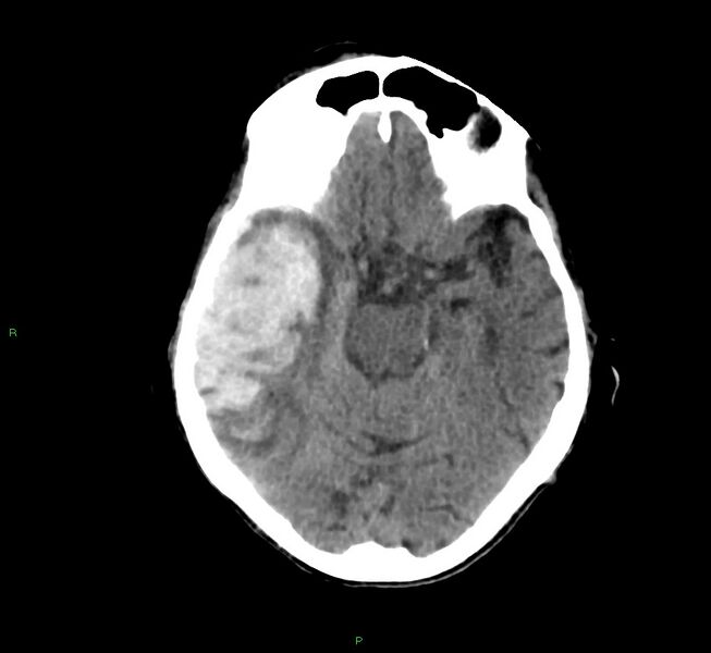File:Cerebral amyloid angiopathy-associated lobar intracerebral hemorrhage (Radiopaedia 58758-65980 Axial non-contrast 32).jpg