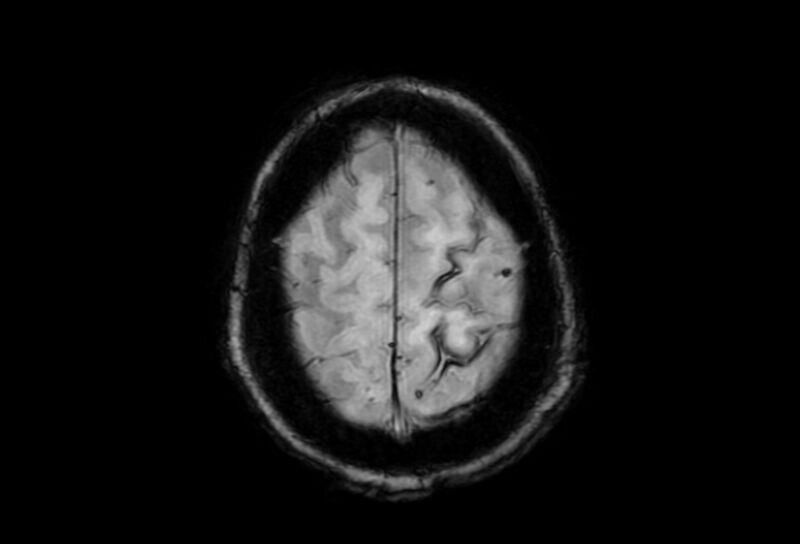 File:Cerebral amyloid angiopathy (Radiopaedia 86671-102792 Axial Gradient Echo 7).jpg