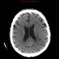 Cerebral and orbital tuberculomas (Radiopaedia 13308-13310 Axial non-contrast 18).jpg