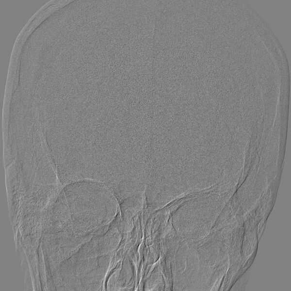 File:Cerebral aneurysm with rupture (Radiopaedia 29933-30458 LT ICA IC 6).jpg