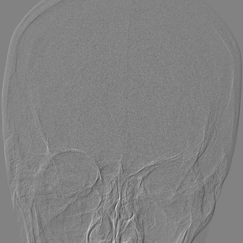 Cerebral aneurysm with rupture (Radiopaedia 29933-30458 LT ICA IC 6).jpg