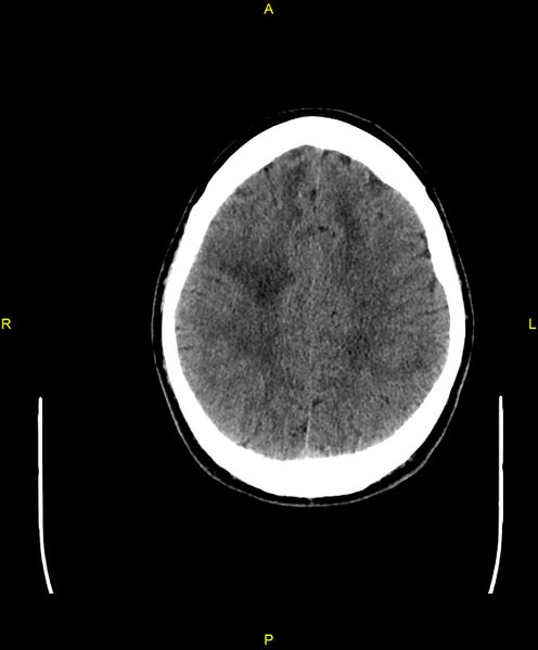 File:Cerebral autosomal dominant arteriopathy with subcortical infarcts and leukoencephalopathy (CADASIL) (Radiopaedia 86108-102051 Axial non-contrast 81).jpg