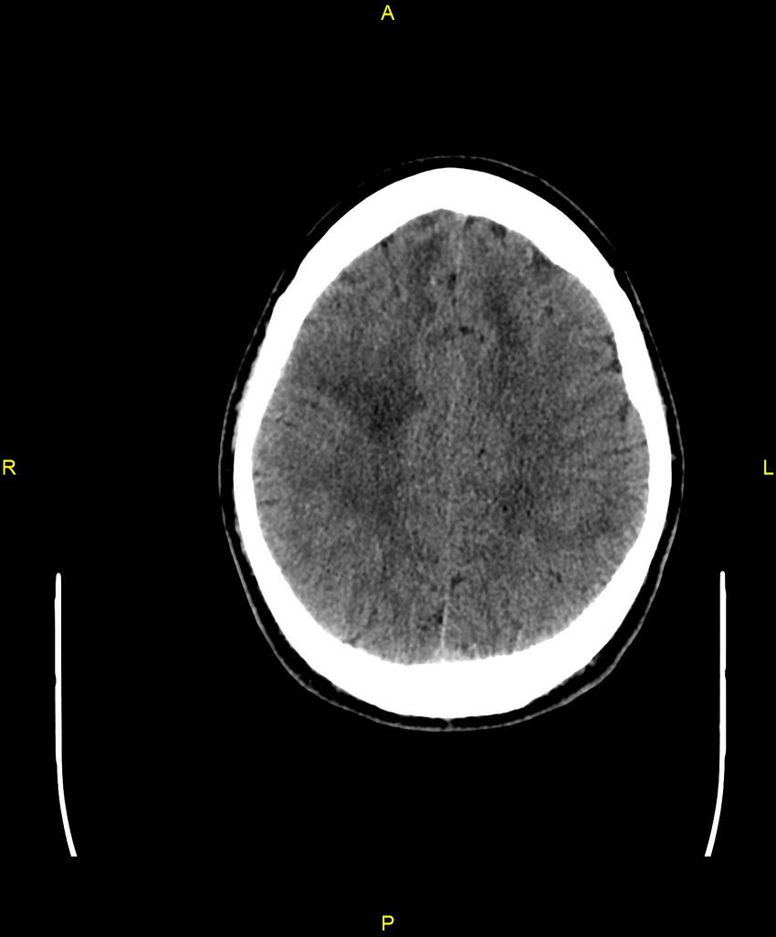 Cerebral autosomal dominant arteriopathy with subcortical infarcts and leukoencephalopathy (CADASIL) (Radiopaedia 86108-102051 Axial non-contrast 81).jpg