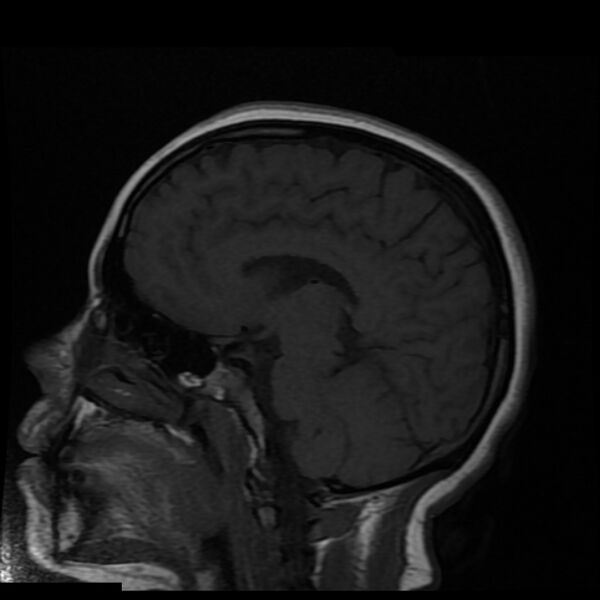 File:Cerebral cavernous malformation (Radiopaedia 44301-47942 Sagittal T1 9).jpg