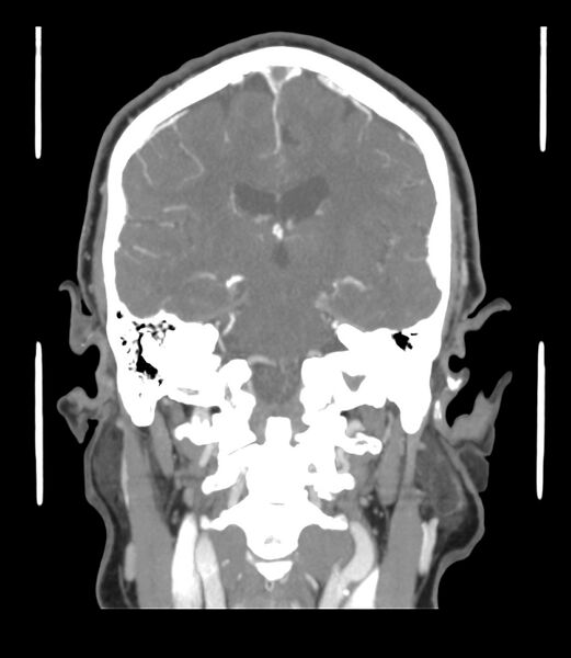 File:Cerebral dural venous sinus thrombosis (Radiopaedia 86514-102576 B 40).jpg