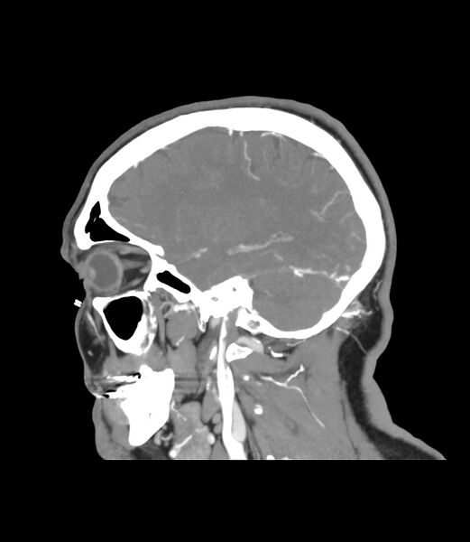 File:Cerebral dural venous sinus thrombosis (Radiopaedia 86514-102576 C 43).jpg