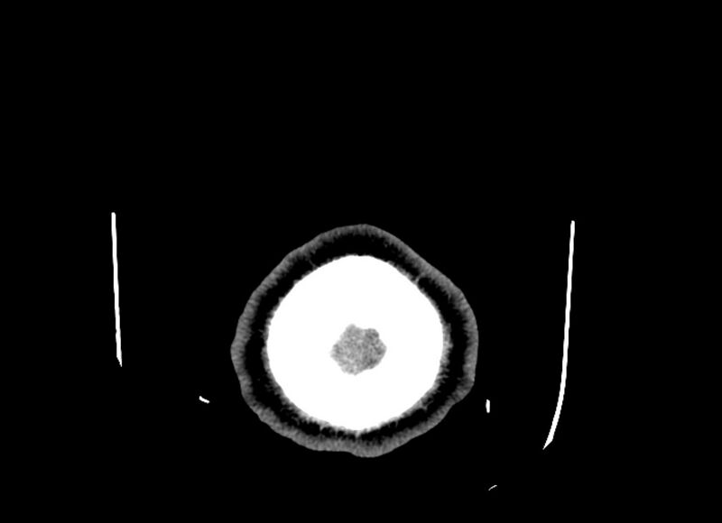 File:Cerebral edema (Radiopaedia 82519-96661 Axial non-contrast 3).jpg